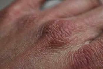 Trockene Haut und ihre Pflege